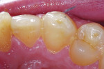 Figure 7 Clinical view of distal surface of maxillary canine. Note the color change evident on the distolingual surface.