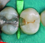Figure 14 Clinical extension of caries parallels the FOTI view of the shadowed tooth that revealed caries.
