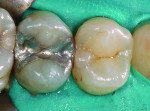 Figure 12 Clinical view of maxillary premolar in normal lighting.