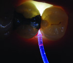 Figure 13 Use of a specialized flexible fiber-optic light guide to position the light source interproximally to better visualize extension of caries on the distal surface of maxillary first premolar.