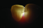 Figure 11 Lingual FOTI position reveals caries on mesial surface of mandibular incisor.
