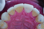 Figure 11 The maxillary lingual contact points were placed in the safe zone, avoiding the margin of the ceramic and tooth interface.