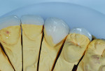 Figure 10 The lingual porcelain extended over the margin of the preparation in order to grasp more enamel and enhance the resistance form.