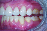 Figure 13 After the addition of composite to tooth No. 22, note the clearance of all teeth in lateral excursion.