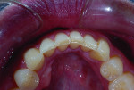 Figure 2 The incisal edge cupping validated that the chemical component was outpacing the frictional damage.