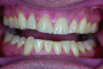 Figure 3 Note the retruded, retroclined, crowded, and lingualized dentition.