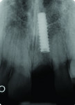Figure 7 Radiograph of fractured implant body in 2008.