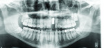 Figure 9 Panoramic radiograph after second implant placement in 2009.
