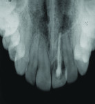 Figure 2 Severe root resorption of maxillary left incisor in 2006.