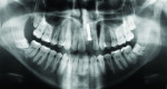 Figure 3 Panoramic radiograph after tooth extraction and immediate implant placement in 2006.