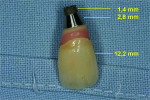 Figure 6 Clinical crown, custom abutment, and coronal portion of implant body fracture in 2008.