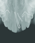 Figure 8 Bone augmentation after troughing of fractured implant body in 2009.