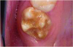 Figure 7 Occlusal view of the maxillary right third molar showing deterioration of the occlusal enamel.