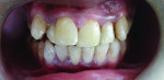 Figure 2 Anterior view of the patient after initial restorative therapy.