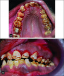 Figure 4 Occlusal and left lateral views after scaling and root planing therapy and prior to restorative treatment of the maxillary anterior teeth.
