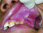 Figure 3 Desquamative lesion on the buccal mucosa near the maxillary left canine.