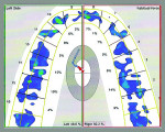 Figure 4 Post-treatment dental bite force balance was confirmed with T-Scan analysis.