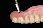 Figure 12  The peripheral borders of the denture were finished with a finishing bur to provide a smooth, seamless transition between the reline material and the denture base.