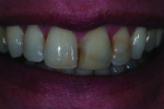 Figure 1 Preoperative view of patient’s smile.