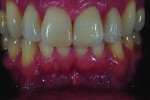 Figure 3 Retracted “after” photo showing the seated alumina crowns.