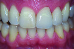 Figure 6 Retracted view of initial try-in of poorly matching crowns.