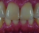 Figure 12 An “after” view showing both crowns
and the natural teeth.
