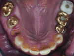 Figure 3 Occlusal preoperative view.