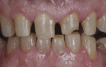 Figure 5 The affected teeth were prepared.
