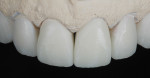 Figure 8 The full-contour anterior crown
restorations were cut back slightly on the incisal
portion to allow for artistic modification.