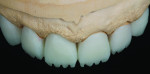 Figure 10 Essence stains were applied to the crowns, which were then fired at 810˚C.