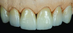 Figure 11 A series of IPS e.max Ceram powders were applied to complete the incisal characterization, after which the crowns were fired at 750˚C.
