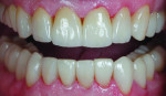 Figure 12 The definitive crowns were
tried in, cleaned with Ivoclean, and cemented
with Variolink luting composite according to the
manufacturer’s instructions.