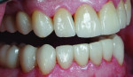 Figure 13 The definitive crowns were
tried in, cleaned with Ivoclean, and cemented
with Variolink luting composite according to the
manufacturer’s instructions.