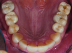 Figure 15 IPS e.max Press veneers were placed on teeth No. 22 through No. 27, and a NobelActive implant was inserted for tooth No. 3.