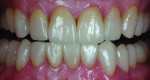 Figure 17 IPS e.max Press veneers were placed on teeth No. 22 through No. 27, and a NobelActive implant was inserted for tooth No. 3.