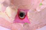 Figure 8 Stacking opacious dentin in the void created by the abutment cutback.
