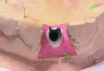 Figure 9 Stacking opacious dentin in the void created by the abutment cutback.