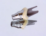 Figure 11 Polishing emergence profile. The goal here is a high shine and a clean finish line between metal and ceramic