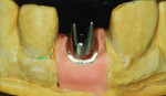 Figure 18 Verifying the fit of abutment before
cutback.