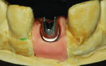 Figure 19 Abutment cut back for GRADIA
Opacious dentin.