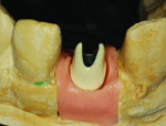 Figure 21 Abutment that was opaqued using GRADIA.