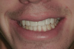 Figure 9 Facial view of the patient’s
natural smile with provisionals in place.
