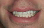 Figure 11 Close-up facial view of the final restorations with the patient in a natural smile.