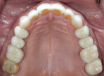 Figure 9 Maxillary occlusal view after treatment; note the conservative anterior restorations.