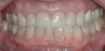 Figure 14 Full-arch retracted view at 5-year followup showing preservation of the post-treatment occlusal relationship.