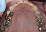 Figure 3 Maxillary occlusal view before treatment showed failing dental restorations placed more than 30 years ago.