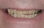 Figure 2 Close-up full smile; when forced to smile, the patient displayed dark, unevenly colored teeth with an irregular incisal edge position.