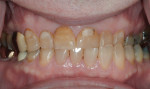 Figure 5 Full-arch retracted view before treatment; note the significant left-side cross bite, as well as generalized exostoses.
