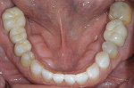 Figure 10 Mandibular occlusal view after treatment; note the improvement in arch form.