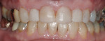 Figure 7 The rough composite mock-ups done at the time of equilibration; note the resolution of the left-side cross-bite and the more favorable form of the anteriors.